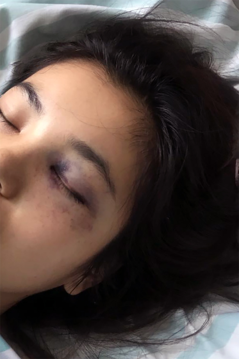 Liu Zengyan in the hospital in August 2019, a day after she was assaulted in August 2019 by her husband at the time.