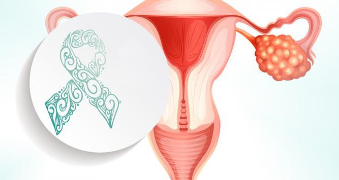 Día Mundial del Cáncer de Ovario: todo lo que debes saber para prevenirlo