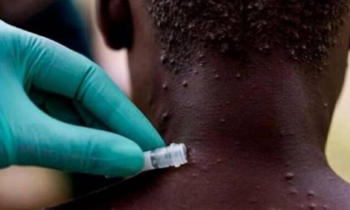 Vacuna contra la viruela brinda protección contra cepa del mono