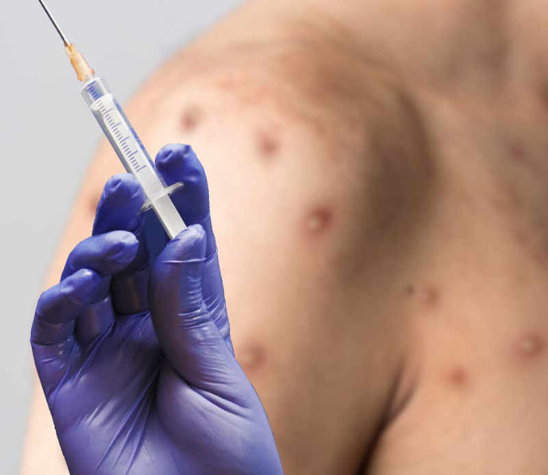 Salud Pública notifica dos nuevos casos de viruela símica en el país