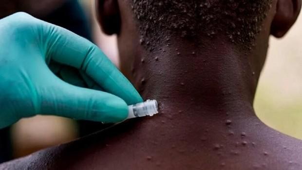 Especialistas critican que Suiza no proponga aún vacuna contra viruela del mono