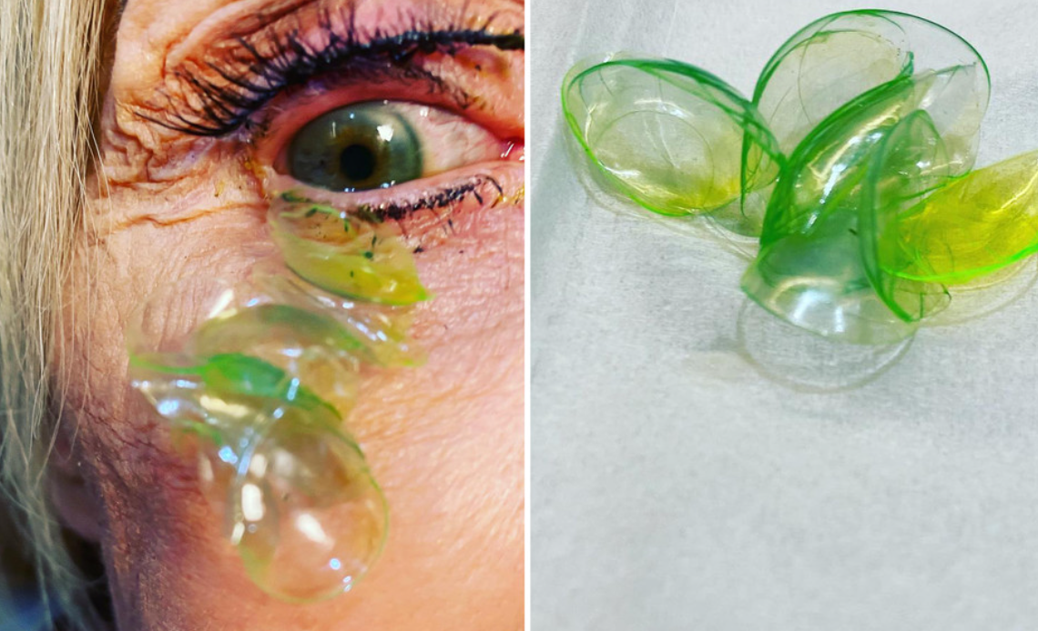 Oftalmóloga remueve 23 lentes de contacto alojadas en el ojo de una señora